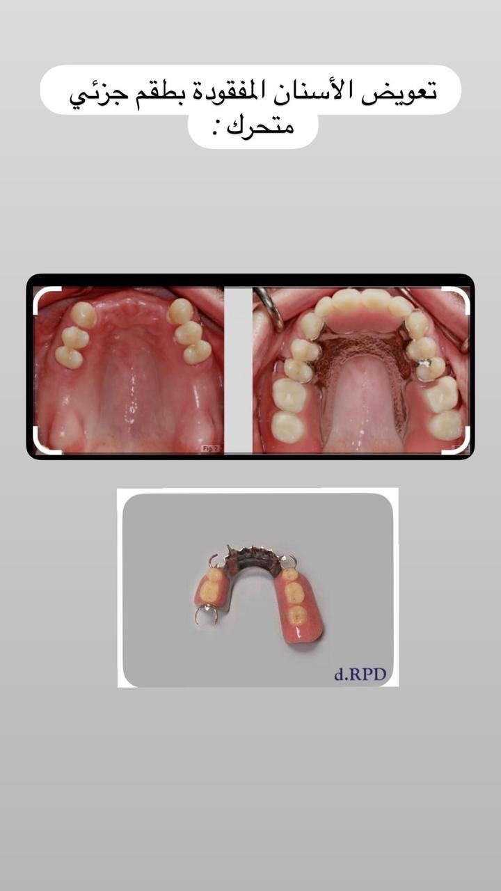 السلام عليكم .. مجاناُ مجاناُ
تعلن عيادات طب الاسنان في جامعة دجلة عن استقبال المراجعين لعلاج الحالات التاليه مجاناً  : 
● علاج الاسنان المتسوسة بالحشوات التجميليه.
● تنظيف الاسنان و ازالة التكلسات .
● قلع الاسنان و جذور الاسنان.
●تعويض الاسنان المفقودة بطقم جزئي متحرك .
العنوان : مستشفى طب الاسنان _ داخل جامعة دجلة.. 
للتواصل : هاتف ، واتساب ، تليكرام ‎***********
انستغرام : dr.fawz_mazin
