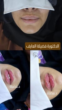 فيلر • د. فضيلة العارف • مجمع وتد بسماية