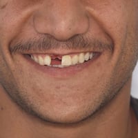 زراعة سن • تعويض فراغ • استعادة ابتسامة