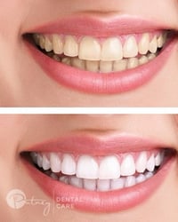 تبيض الأسنان بالليزر + تنظيف الاسنان خصم 50% كذلك عرض على شخصين للاستف...