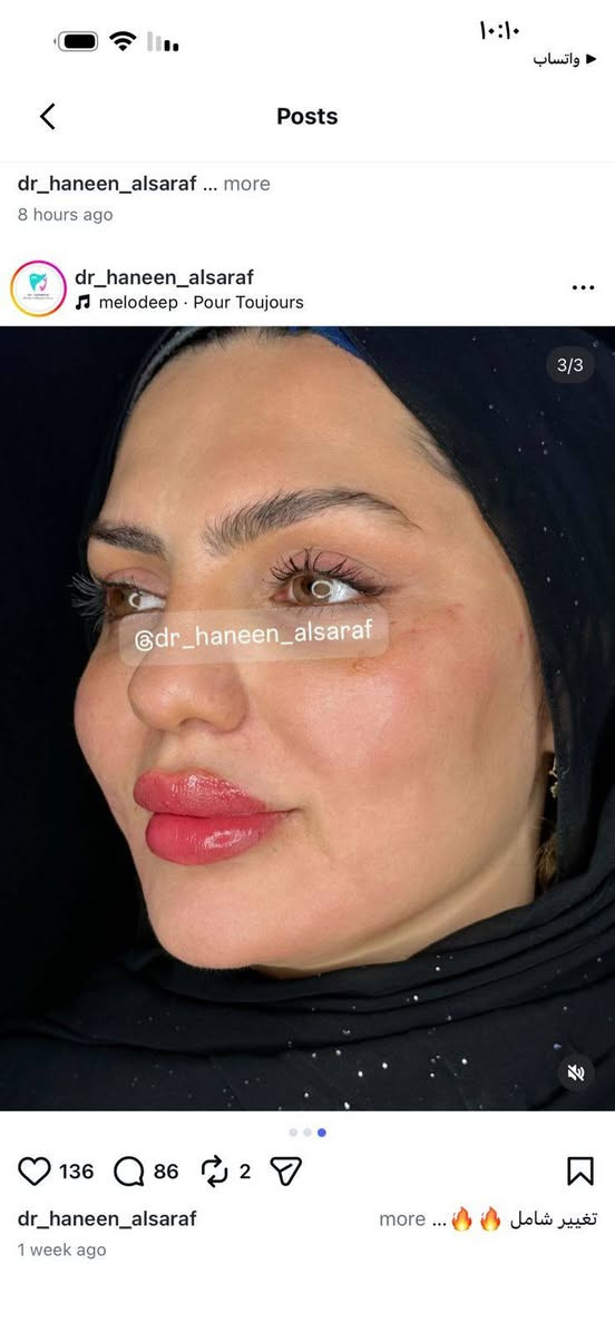 تحت إشراف الدكتورة [حنين الصراف] نقدم لكم أحدث تقنيات الحقن التجميلية بأعلى معايير الأمان والدقة للحصول على نتائج طبيعية تبرز جمالكِ الحقيقي دون مبالغة.
💎 بوتوكس 💎 فيلر الشفاه والخدود 💎 تحديد الكونتور والفك 💎 جلسات النضارة والترطيب العميق 💎 استشارات تجميلية متخصصة
✔️ خبرة واحترافية ✔️ مواد أصلية ومعتمدة ✔️ نتائج طبيعية تليق بجمالكِ
الدكتورة حنين الصراف 
كوني النسخة الأجمل من نفسكِ... فالجمال الراقي يبدأ مع الاختيار الصحيح. ✨🤍

💖  عنوان الجمال الراقي للسيدات
#تجميل #بوتوكس #فيلر #نضارة_البشرة #جمال_راقي #كوت

ورابط صفحة الطبيبة على الانستكرام:- 
‏https://www.instagram.com/dr_haneen_alsaraf/

رابط صفحة الطبيبة على الفيسبوك:- 
‏https://www.facebook.com/Haneenclinic1?mibextid=ZbWKwL

عنوان الطبيبة 
https://maps.apple/p/N9-Xe99xRLrvZf

📍 العنوان:- | العراق | الكوت | شارع الهورة | بناية ابن فنجان | مجمع الطبيب الجراح | الطابق الثاني

📞 للحجز والاستفسار:- 
***********
📞 ***********
📞 ***********
💖  عنوان الجمال الراقي للسيدات
#تجميل #بوتوكس #فيلر #نضارة_البشرة #جمال_راقي #كوت
تحت إشراف الدكتورة [حنين الصراف] نقدم لكم أحدث تقنيات الحقن التجميلية بأعلى معايير الأمان والدقة للحصول على نتائج طبيعية تبرز جمالكِ الحقيقي دون مبالغة.
