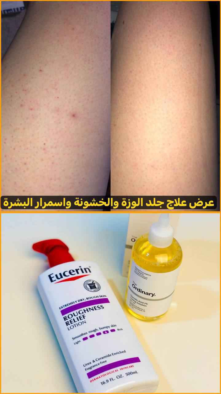 ♥️ خاص♥️ لعلاج جلد الوزة
عرض لترطيب وتقشير  وتفتيح الوجه والجسم وازاله جلد الوزه يتكون 👈تونر اوردنري + مرطب يوسرين 

🤍 تونر اوردينارى الكندي الاصلي💯‌🇨🇦⁩
بحمض الجليكوليك يعمل على تقشير البشرة تقشير خفيف و ايضآ لا يسبب جفاف البشرة او تنشيفها 
يقلل من إفراز البشرة الدهنية
■يقلل الخطوط الرفيعة و الخطوط التعبيرية في البشرة و بيعمل على توحيد لون البشرةو علاج البقع البنية و التصبغات
■يحتوى على AHA الذى يعمل على جعل البشرة صحية و مضيئة و فيها نضارة و اعطاؤها مظهر صحى. 
■يحتوى على الالوفيرا الذى يقلل من احمرار و تهيج البشرة ✨
■خالى من الكحول و السيليكون و الزيوت ✔️✔️

♥️ مرطب يوسرين
يحتوي على الفا هيدروكسي واليوريا ترطيب يدوم 48 ساعه
ينصح به أطباء الأمراض الجلدية
بتعانيمن جلد الوزه اليكي هذا المرطب السحري تفتيح وترطيب عالي يعالج البشره الجافة وشديده الجفاف والمتشققه والمصابه بالحكه لوشن مفيد وآمن لاصحاب البشرة الحساسه والبشرة التي تعاني من الاكزيما

منشأ العرض امريكي 🇺🇸💯 
🚘يوجد خدمة توصيل لجميع محافظات العراق بغداد, العراق


**إذا كنت صاحب هذا الإعلان وتريد حذفه لأي سبب، رجاءا أرسل رسالة إلى الدعم الفني**