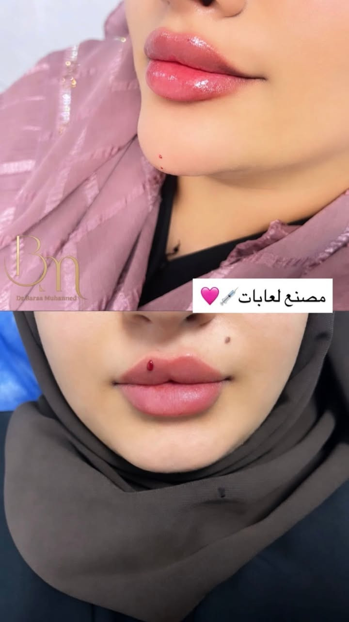 مع كثرة عيادات التجميل تتميز الدكتورة براء السوداني بنظافة وجمال الشغل عنوان العيادة شارع الاطباء قرب السوق الصغير مجاور مركز السفير داخل عيادة فيروز 
للحجز السريع او الاستفسار واتساب ***********
