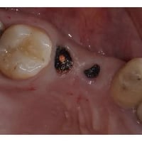 طالبة طب اسنان • قلع اسنان • كلية طب الاسنان