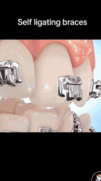 تقويم أسنان • تقسيط 12 شهر • تخفيض 40%