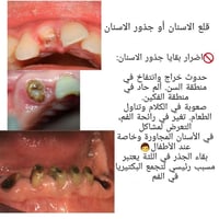 قلع جذور • مجاني • عيادات بيارق العميد