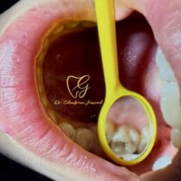 حشوة ضوئية • جلسة واحدة • شارع المحكمة