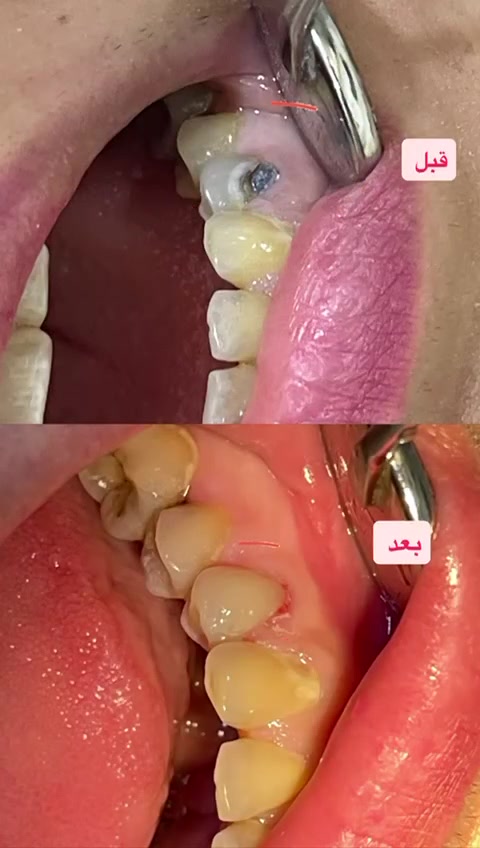 عيادة الماسة لطب الاسنان والتجميل 
للحجز والاستفسار 
***********
#عيادة #اسنان #عيادةـاسنان #جويبة #الماسة #حشوات #تجميل
