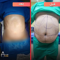 نحت البطن • شفط دهون • عملية تجميل • شد ترهلات • جراحة تجميلية • نحت ا...