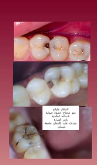 علاج مجاني • حشوة ضوئية • جامعة ميسان