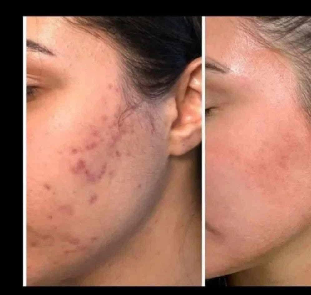 تۆش بەدەست کێشەکانی پێستەوە دەناڵێنی نازانی چی لێبکەیت و بەچی چارەسەری بکەیت🤔
کرێمێکت دەوێت بەگرەنتی👌 پارەگەڕانەوە ئەگەر سوودی نەبوو لەماوەی تەنها 🔺١٥ڕۆژدا
🟡سێتی کرێمی ئەمەریکی ئەڵلماس کەخاوەنی کوالێتی کۆنترۆڵە ☑️
ئەوەی ئەم کرێمەی بەکارهێناوە بۆهەمیشەیی ماڵئاوای لەتەواوی کێشەکانی ڕوخساری کردوە و دەوروبەری داوای ئەم کرێمەیان لێکردوە بەهۆی سوودو گۆڕانکاریە زۆرەکەیەوە 👍
ئەم کرێمە چارەسەری تەواوی ئەم کێشانەی ڕوخسارت بۆدەکات بەگرەنتیەوە 
🔺لابردنی زیپکەو شوێنەواری زیپکە
🔺لابردنیی پەڵەی سەرپێست و ژێرپێست
🔺لابردنی ڕەشی ژێرچاوو یەک ڕەنگ کردنی روخسار بەتەواوی
🔺لابردنی سوتاوی بەرخۆرو نەرم کردن و سافکردنی دەماوجاوو بەگشتی یەک ڕەنگردنی 
🟡کارتی گرەنتی و زەمانی بەکارهێنانی لەگەڵدایە سوودی تەواوت وەرنەگرت قەرەبوی تەواو دەکرێیتەوە 
بۆداواکردن و زانیاری زیاتر پەیوەندی بەم ژمارەیەوەبکەن
🚕گەیاندنمان بەردەستە 
📞***********
