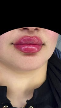 فلر شفة • د. ايثار سامي • الكوت الهوره