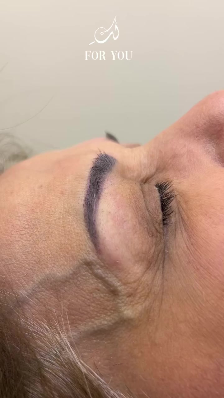 قبل وبعد إزالة التاتو بالأحماض ✨
فرق واضح ونتيجة تدريجية وآمنة

العنوان : 
بغداد الجديدة الشارع العام تقاطع الدرويش مقابيل ابو توني 

للتواصل : 
***********
***********
