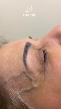 قبل وبعد إزالة التاتو بالأحماض ✨ فرق واضح ونتيجة تدريجية وآمنة  العنوا...