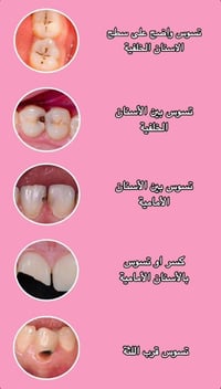 اي احد محتاج حشوة ضؤية نفس الصورة يراسلني علما ان المعالجة مجانية ولفت...