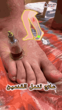 حجامة بسمايه الصحيه
لعلاج الضغط والصداع والشقيقه والام الظهر والدسك والفقرات وعرق النسا والمتن للاطفال وشلع السره وللحجامه تعالج ضعف النظر والتهاب الجيوب 
والام القدم وعلاج النتوء كل هذا وصحه وعافيه على الجميع 
واكيد الحجامه وقايه وعلاج
***********
