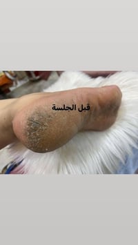 جلسة بديكير للقدم جلسة بديكير للقدم عميقة تقشير ازالة الجلد الميت تبيض...