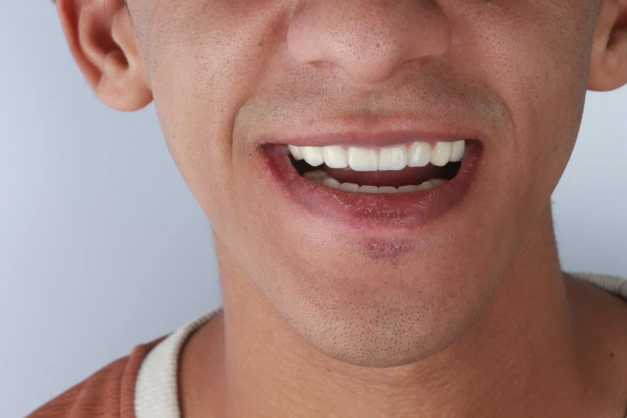 ✨ ابتسامتك تستاهل الأفضل
نرجع لك ابتسامتك بثقة من خلال:
🦷 زراعة الأسنان الفورية
🦷 تركيبات تجميلية طبيعية
🦷 حشوات ضوئية بأحدث التقنيات
✔ نتائج طبيعية وراحة عالية
✔ مواد من شركات عالمية موثوقة
✔ عناية خاصة بكل حالة
📍 حي الحضارة – مقابل فلكة النسر
📞 احجز الآن: ***********
📩 أو راسلنا على الصفحة
ابتسامتك تبدأ من هنا 😁🦷
