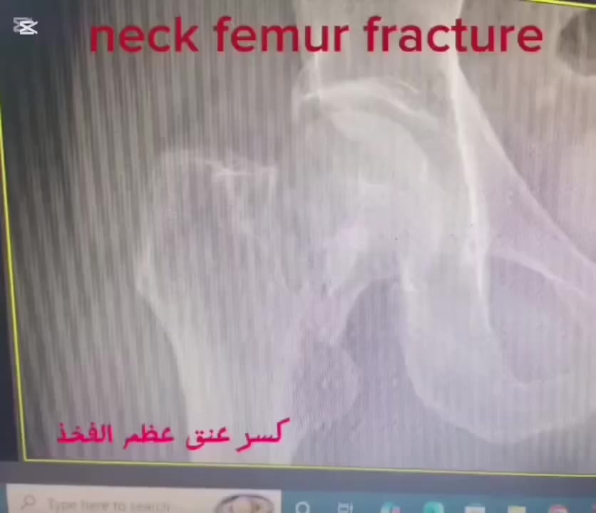 🔴 يوم الخميس عصرا يتواجد الدكتور حسن محي الدين رشيد 

                         دكتوراه أخصائي امراض وجراحة العظام والكسور والتهاب
✅عمليات تبديل المفاصل 
✅ عمليات الأصابات الرياضية
✅جراحة العظام والكسور
                                    
 🟢 للحجز والاستفسار  :*********** - ***********

🟢العنوان / مجمع الثقة الطبي طوزخورماتو / شارعة الصاغة / قرب مدرسة يافا الابتدائية
