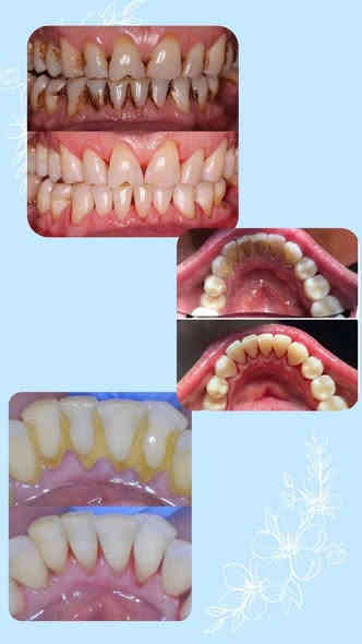 السلام عليكم ورحمة الله وبركاته 
الي يحتاج قلع جذور متبقية او تنظيف تكلسات او حشوات متواجدين بالعيادات وبشكل مجاني كامل 
موقع العيادة الحلة شارع اربعين مجاور صيدلية سلامتك
***********  للتواصل على هذا الرقم
