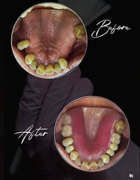 مجانا مجانا 🔴 طقم اسنان جزئي متحرك للتواصل 07715300245 العنوان بغداد ا...