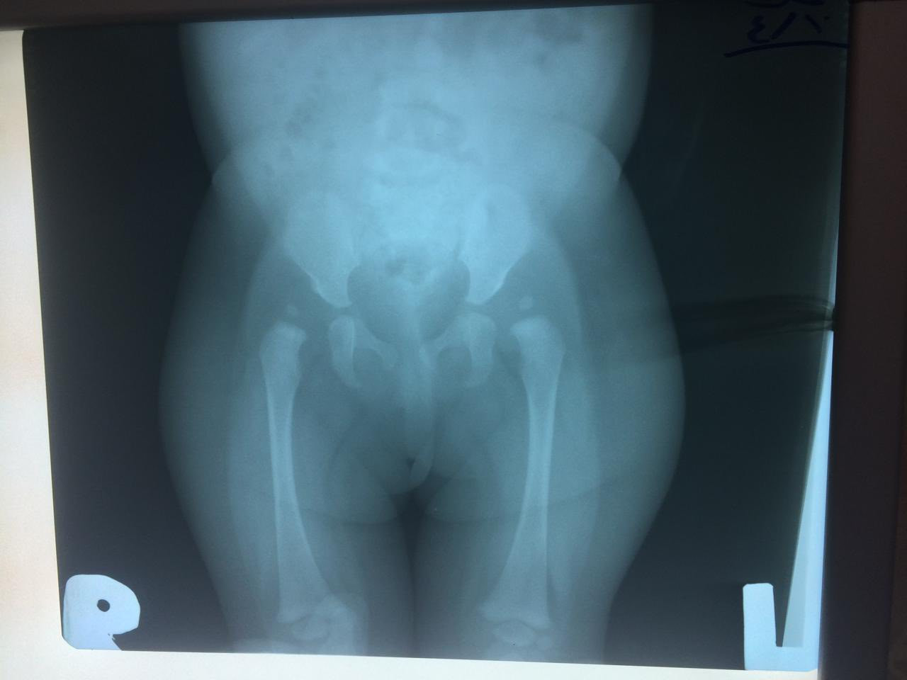 الخلع الولادي لمفصل الوركين هو من التشوهات الولادية الشائعة وخصوصا في الإناث حيث يكون راس عظم الفخذ خارج الحرقفة او ما هو متعارف عليه بين الناس بالفنجان وهذا ان ترك يؤدي إلى تاخر المشي مع عدم اتزان في المشي لاحقا و يتبعه سوفان مبكر في مفصلي الوركين 
الحالة لهذا اليوم طفلة عزيزة جلبها أهلها و الحمدلله بشكل مبكر مما أدى إلى تشخيصها بشكل مبكر وتم اجراء عملية بسيطة لها تضمنت قص أوتار العضلات القابضة للوركين مع تجبيس ..
الأهل كانوا متفهمين ومتعاونين جداً، تم متابعة الحالة بشكل دوري و تم وضع مسند خاص مع متابعة نمو المفصلين بعد إرجاعهما بشكل صحيح. النتيجة والحمد لله كانت رائعة.
ثم بعد سنوات زارت العيادة وكانت تمشي بشكل رائع ومتزن، وإذا مرضت فهو يشفين. الفضل لله … فقد هدى عائلة الطفلة إلى فحصها ومتابعتها مبكرا مع الحرص الشديد والمتابعة واعطى ذلك ثمرته باذنه تعالى.

اخيراً التشوه شائع ويكثر في العوائل التي لها تاريخ مرضي مع هكذا أمراض وينصحون دائما بالتأكد من كل مولود قريب هذا يجنب المريضة اربع عمليات إذا تعدى عمرها السنة … عمليتين لكل ورك … او يجنبها التعرض إلى عملية زرع مفصل مبكر للورك وفي عمر مبكر فضلا عن جميع الالام والمخاطر المترتبة على ذلك.

العيادة تستقبل جميع حالات التشوهات الولادية وتتقدم جميع الخدمات المتعلقة بها.

الدكتور يونس الرضواني
دكتوراه اختصاص جراحة العظام والمفاصل والكسور
بغداد /المنصور- شارع ابو جعفر المنصور- سايد كباب محمد بعد فرع جوزات المنصور- مجاور صيدلية انكيدو
للحجز والاستفسار
***********

#كسور #مفاصل #جراحة_العظام
