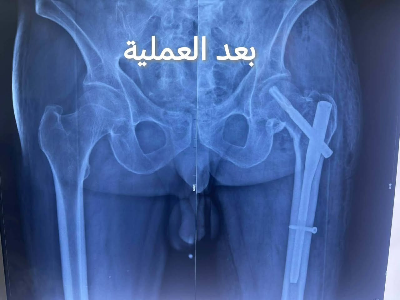 مريضة تبلغ من العمر٧٤سنة تعرضت لحادث سقوط على اثرها تعرضت لكسر في اعلى عظم الفخذ تم تشخيص الحالة من قبل الدكتور حيدر فرعون الجبوري  اختصاص جراحة الكسور والمفاصل تم تحويل المريضة الى المستشفى بعد اجراء كافة الفحوصات وتحضير المريضة وتم اجراء عملية تثبيت الكسر وهي الأن تتمتع بصحة جيدة دعواتنا لمريضتنا بالشفاء العاجل وتمنياتنا للدكتور حيدر فرعون الجبوري اختصاص جراحة العظام والكسور وتبديل المفاصل  بالتوفيق أن شاء الله ومزيد من العلم والمعرفة
للحجز والاستفسار ***********
