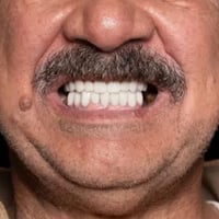 تنضيف الأسنان وفحص مجانا علينا ازرع او ابتسامة  حسب اخيتارك قشور ايماك...