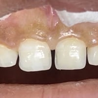 عيادة الطائي • حشوات تجميلية • سبعالبور