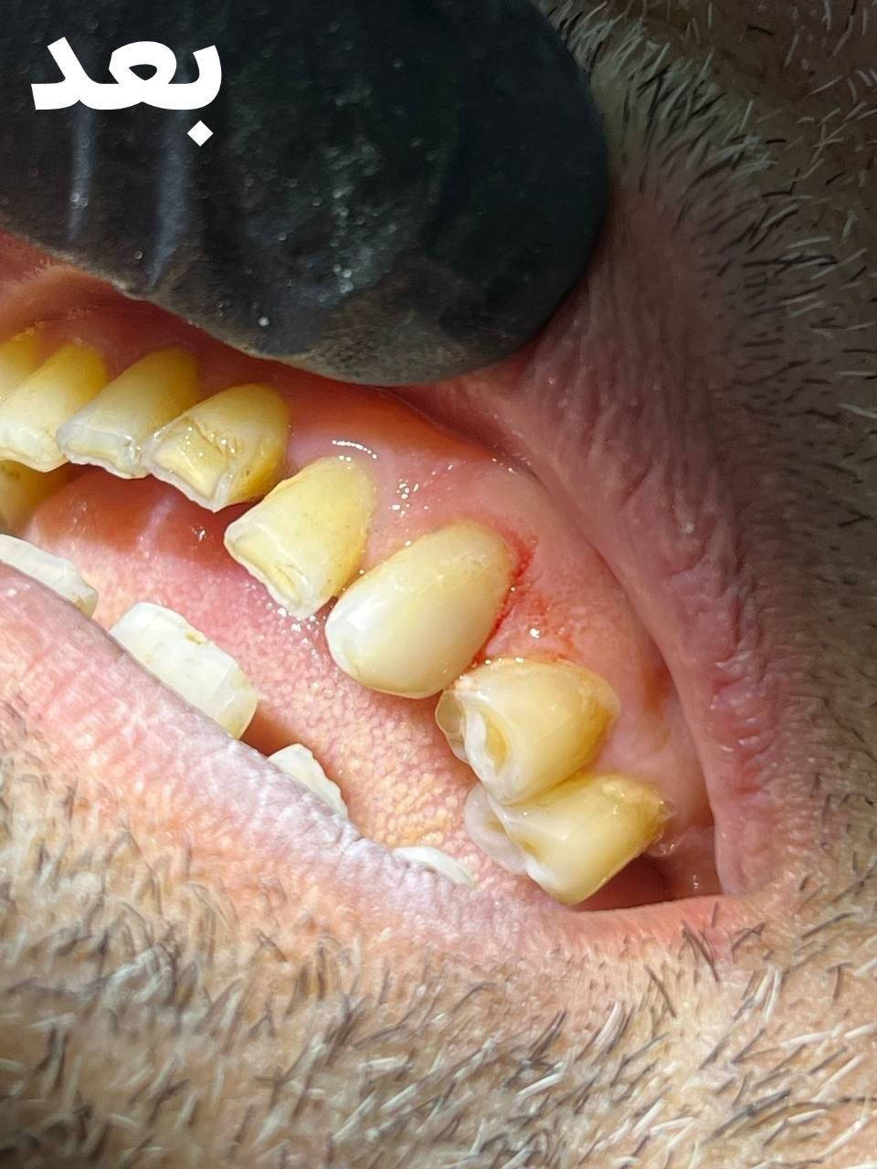 حشوة تجميلية بضمان دائم من عيادتنا🦷
جمال الشغل والنظافه زورونا بلعيادة متواجدين يوميأ 😍

المكان/ حي 17 الشارع العام لمكتبة المهندس مجاور لمدرسة المشاعل
للحجز والاستفسار/ ***********
