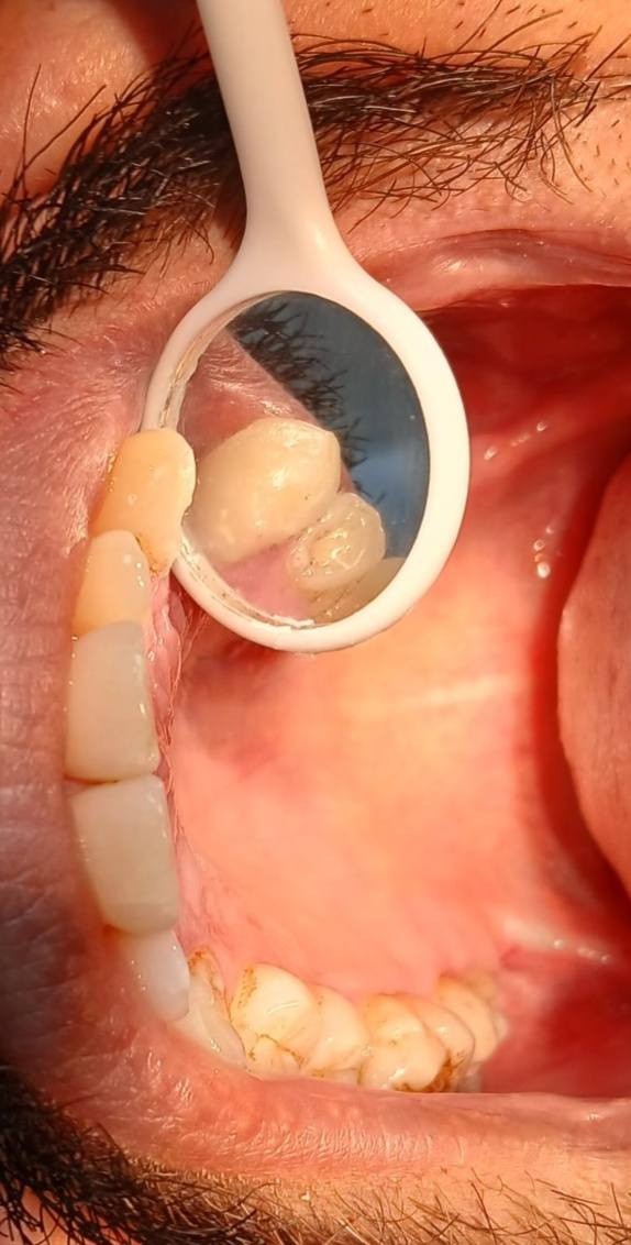 مجانا مجانا مجانا
تنظيف الاسنان وازالة التكلسات
حشوات ضوئية تجميليه
قلع وتعويض الاسنان
تعويضات متحركة مرنه
*********** واتساب
