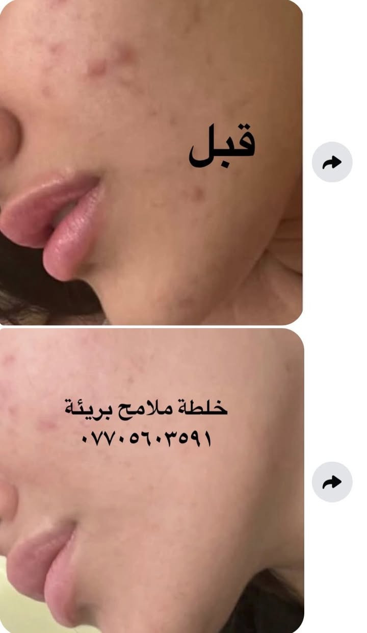 عليها القرأن الي مجربه براندي خلطة ملامح بريئة وفايدها تعلق اهنا بنات يتابعون التعليقات يردون يستخدموهاويستفسرون منكم  👈🌹


**إذا كنت صاحب هذا الإعلان وتريد حذفه لأي سبب، رجاءا أرسل رسالة إلى الدعم الفني**
