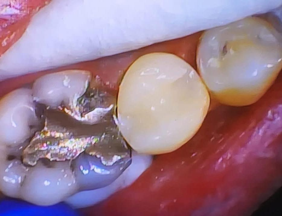 ترميم وبناء سن بحشوة زاركون يابانية تجميلية مع وتد
طبيب الاسنان الاختصاص د.عمار عباس
ماجستير تقويم وتجميل الاسنان M.S.c ortho
بكلوريوس طب وجراحة الفم والأسنان B.D.S
بغداد الشعب شارع عدن قرب  مركز شرطة الشعب  مدخل سوق شلال عمارة باريس الطابق الاول دوام العيادة جميع ايام الاسبوع ما عدا الجمعة عطلة من ٤ ل ٨  بدون حجز مسبق الدخول حسب اسبقية الحضور للعيادة الفحص والمعاينة مجاني للاستفسار ***********
