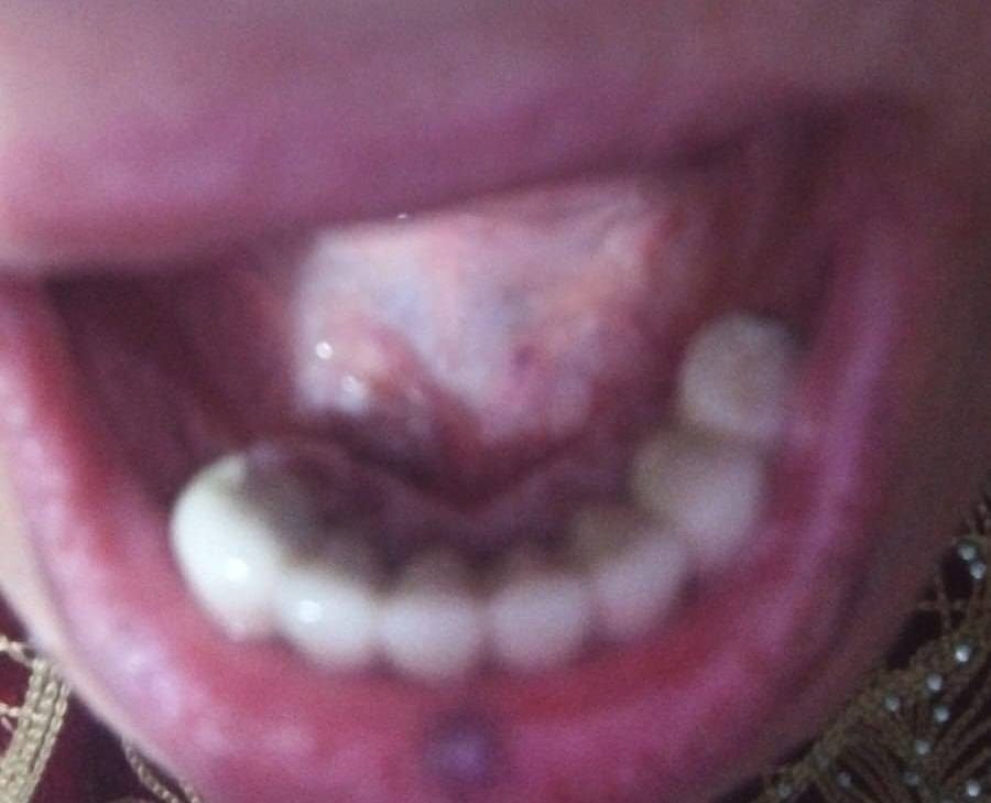 السلام عليكم الي يحتاج تخم اسنان نقدمه مجاني تحت اشراف دكاترة مختصين استغلو الفرصة خلال الكورس الثاني حتة نكمل الجلسات قبل رمضان و قبل لا تخلص السنة الي يكدر يجي لجامعة المشرق بشارع المطار يتواصل وياي
و نوفر ايضا قلع حشوات تجميلية 
تواصلت على الرقم واتساب *********** او معرف @NbooHas
