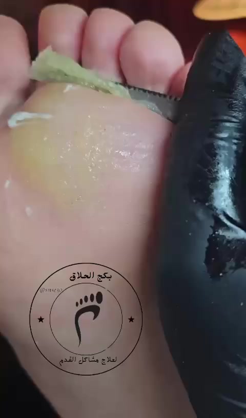 تعبت من التشققات اللي توجعك أو شكلها مو حلو؟ جربت هواية كريمات وما فادت؟اليوم جايب لكم الحل بكج كامل++ (عن تجربة شخصية وضمان اذا ما شفت فرق من اول استخدام ترجع المنتج وترجع فلوسك]

✅ مناسب للرجال والنساء.
✅ فعال جداً للناس اللي توقف هواية أو تمشي مسافات.
✅ نتائج حقيقية وملموسة من أول أيام.
السعر 15 الف
[التوصيل داخل مدينة الصدر 3 الالف خارج المدينه 5]
للحجز والاستفسار
واتساب ***********
