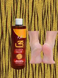 كالوس كرم جي • تشققات القدم • علاج نهائي