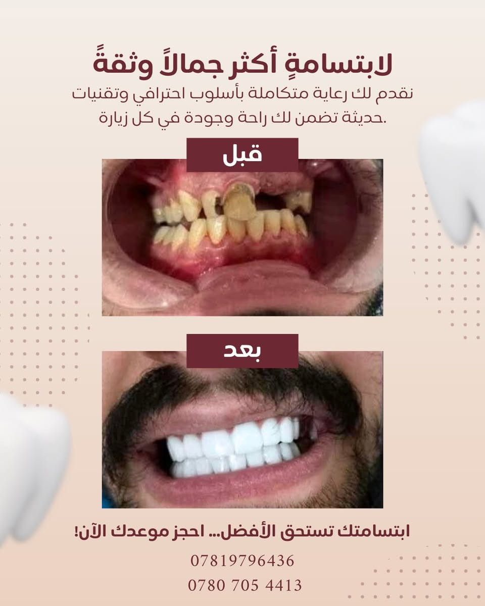 بشرى سارة 🌿

إلى أهالي الغزالية الكرام:

يسرّنا إعلامكم بـ اعلان عروض عيد الفطر المبارك في عيادة طب الأسنان التخصصية د.رسل رعد
 ونعلن عن تخفيض خاص بنسبة 50% ولمدة محدودة يشمل جميع الإجراءات العلاجية:

🔹 الحشوات التجميلية
🔹 حشوات الجذور
🔹 قلع الأسنان الاعتيادي والجراحي
🔹 تقويم الأسنان
🔹 زراعة الأسنان
🔹 تبييض وتنظيف الأسنان

✨ الفحص مجاني

💚تتوفر خدمة العلاج بالأقساط

📍 العنوان: الغزالية – شارع البدالة، مقابل مختبر مختبر اوركيد، مجاور صيدلية صيدلية محمد فليح
📞 هاتف العيادة: ***********
 0780 705 4413
🕓 أوقات الدوام في شهر رمضان المبارك بعد الافطار: من الساعة 7:00 مساءً ولغاية 11:00 مساءً

أهلاً وسهلاً بكم 🌸
صحتكم تهمّنا دائمًا
