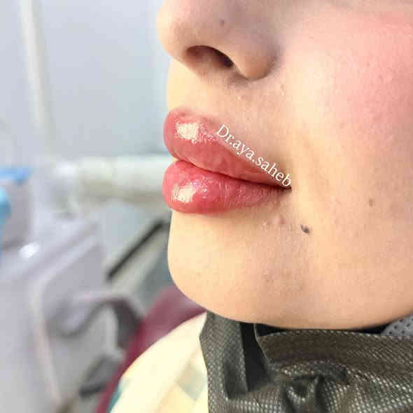 ⁨ حقن شفة بالطريقة الروسية الاوڤر لمحبين الشفاه البارزه🍒🍓
#فلر_ايطالي 
للحجز والاستفسار /***********
#الديوانية #فلر_شفايف #فلر #فلر_الشفايف #فلر_شفاه #فلر_شفة #فلر_شفايف👄 #اكسبلورر #اكسبلور_فولو #اكسبلور_explore #اكسبلور⁩
