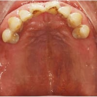 منو محتاج تعويض لاسنانه او عنده مثل هاي الحاله 👇 للحجز والاستفسار تواص...