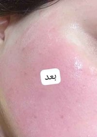 ابر تفتيح • نضارة البشرة • استعمال خارجي