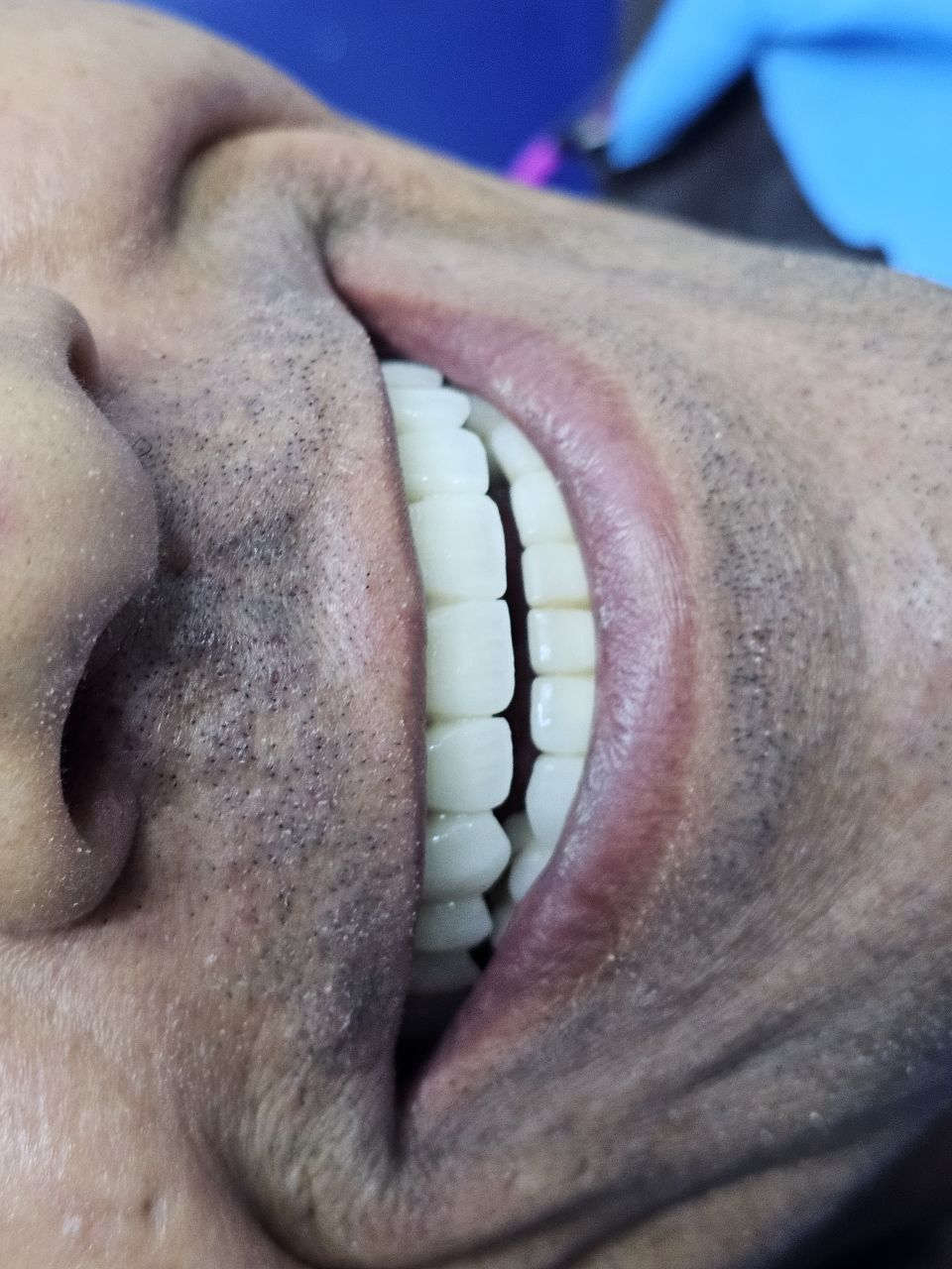 مريضنا اليوم يعاني من صحة فموية سيئة جدا (مدخن قديم)
نخور كبيرة ومعممة..
ألم في معظم الأسنان 
صعوبة المضغ وتناول الطعام ومشاكل أخرى كثيرة تمت معالجتها جميعها بإجراء تجريف للنخور ومعالجات لثوية وجذرية للأسنان وإجراء تغليف كامل حتى حصلنا على هذه النتيجة المرضية
#Smile_with_confidence 
#مركز_الشام_الطبي 
#واسط_الكوت_قضاءالحي 
#د.أيهم_محمد_أحمد 
#للحجز والاستفسار:
***********
