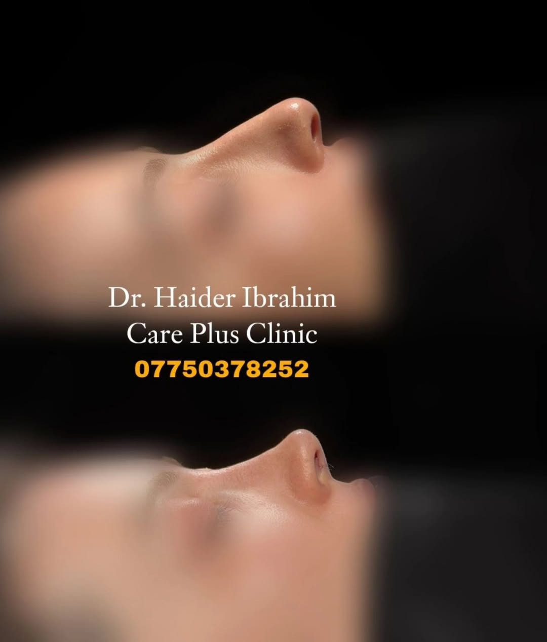 ✨ تجميل أنف أنثوي برسمة متناسقة تناسب ملامح الوجه ✨

نتائج طبيعية ولمسة جمالية تحافظ على تناسق الوجه، مع تصميم يناسب ملامح كل حالة بشكل فردي للحصول على مظهر أنثوي ناعم وجذاب.

👨‍⚕️ الدكتور حيدر إبراهيم 📍 متواجد يوميًا لاستقبال المعاينات والحجوزات. 📞 ***********

#تجميل_الأنف #رأب_الأنف #أنف_أنثوي #تجميل #نتائج_طبيعية جراحة_تجميل الدكتور_حيدر_إبراهيم بغداد العراق
