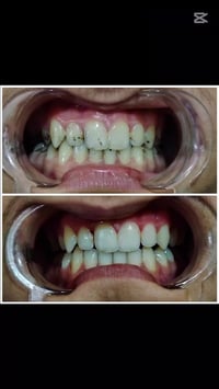 تنظيف اسنان • بوليش اسنان • بعقوبة التحرير