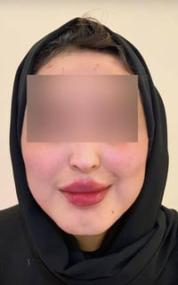 فلر شفة • عيادة سنايا • كربلاء الجمعية