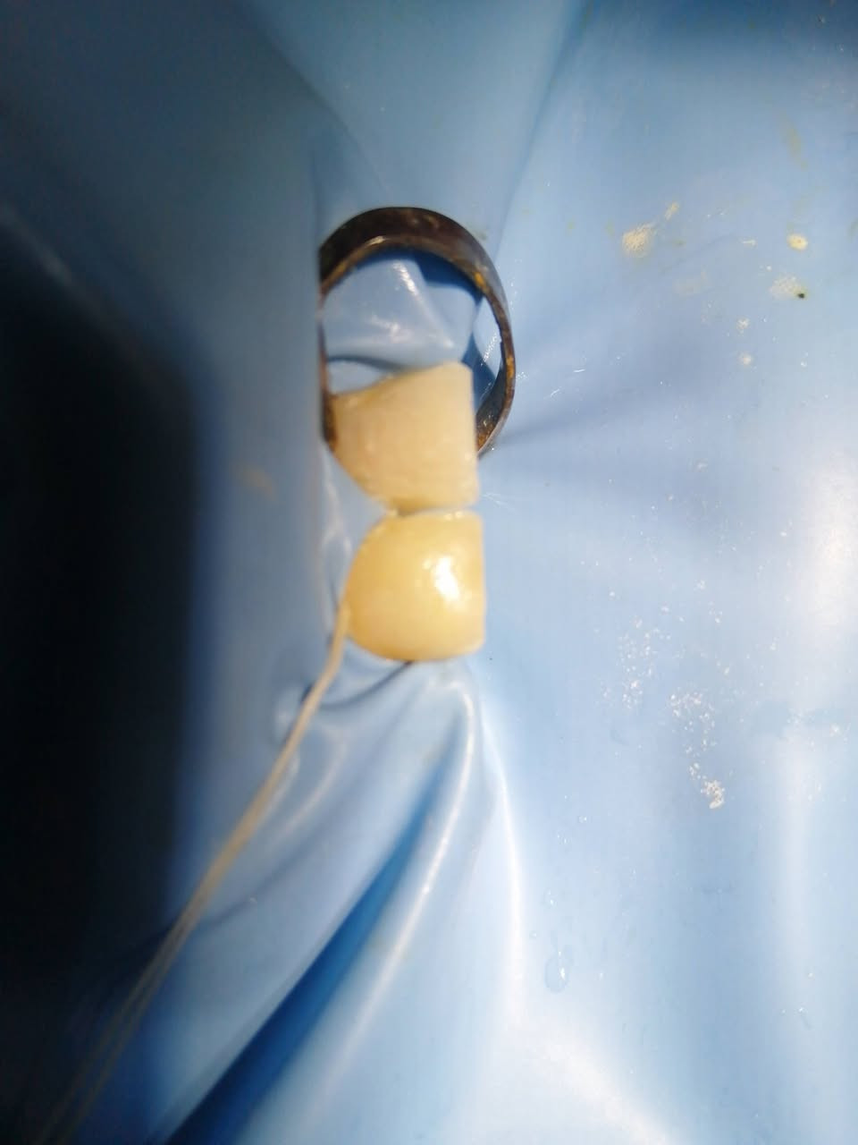 ترميم السن الأمامي المكسور ..
د مهند عبد الجواد الطحان الهاشمي
ماجستير ودبلوم عالي تعويض الأسنان.. سايدين مستشفى #القيارهالعام.. للحجز والاستفسار التواصل على الرقم ***********# مجاور صيدليه عبدالله المعماري.. طابق ارضى.
