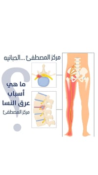 مركز المصطفئ • عرق النسا • علاج طبيعي