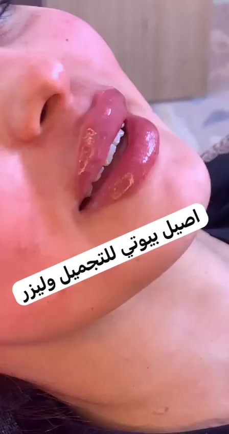 اصيل بيوتي للتجميل وليزر
رؤى الجبوري 

شارع الصالونات مجاور شركة اسيا سيل

نفس عماره باور جم طابق ثاني❤️

***********

لحگوا عرووض ونتائج👌💉
