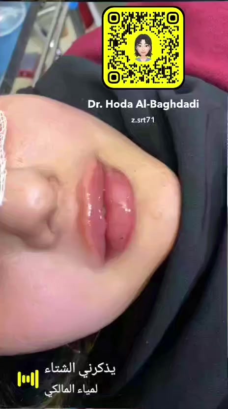 هلووو حبايبي واليوم صار العرض ويايه فيلر  شفه سيسي ٤٠ الف فقط لمدة يومين ❤️😘
سارعو للحجز 
ع صفحه الخاصه 
اوالرقم تالي ***********
