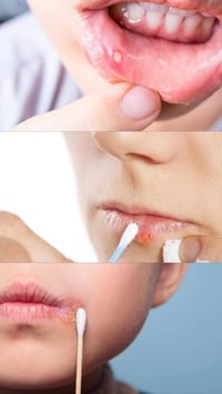 الي عنده تقرحات بالفم او باللسان ويحب يعالجهم مجانًا خلي يتواصل وياي  ...