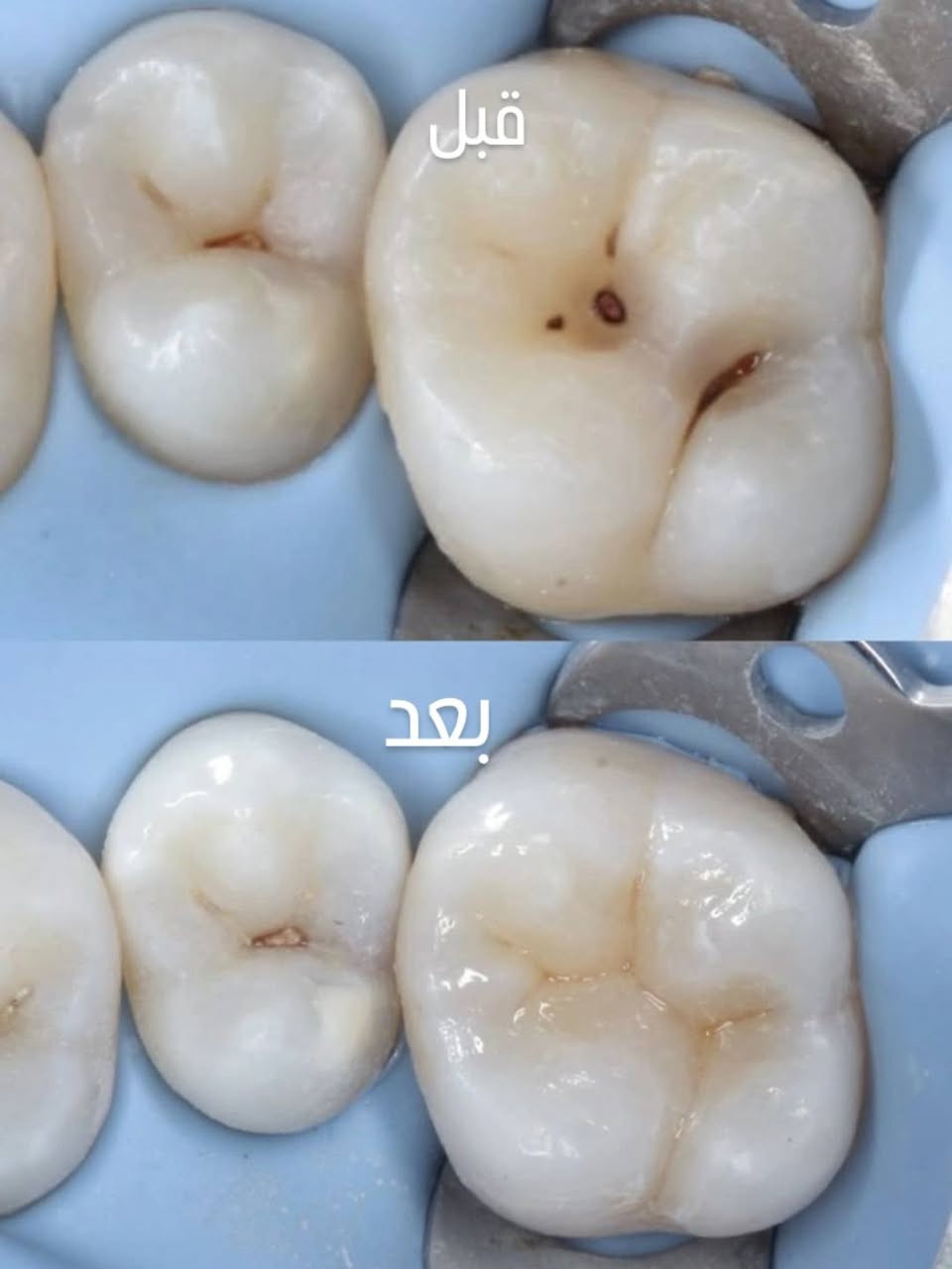 السلام عليكم نعلن عن توفير علاج للاسنان مجاني فقط لفترة اسبوع بعد العيد مباشرتا سارع في حجز موعدتك حشوات تنظيف قلع 
مجاني 
العنوان شارع فلسطين عيادات جامعه المصطفى خلف الجامعة المستنصرية قرب تقاطع الموال للحجز راسلونا على ***********
